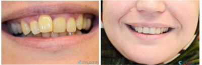 before-and-after-braces