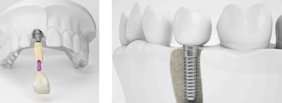 dental-implants-demo