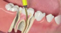 Root Canal ›