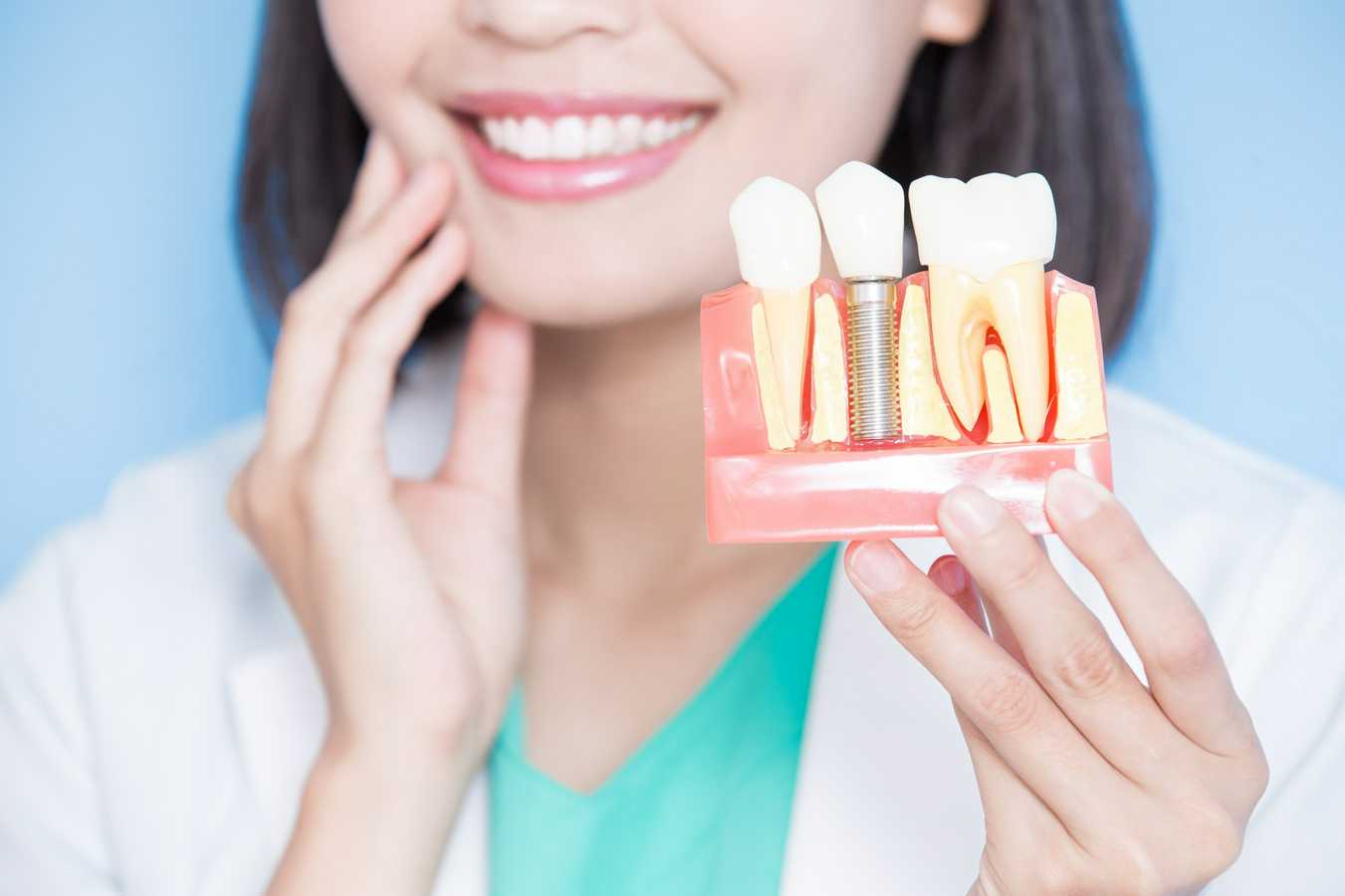 dental-impants-image