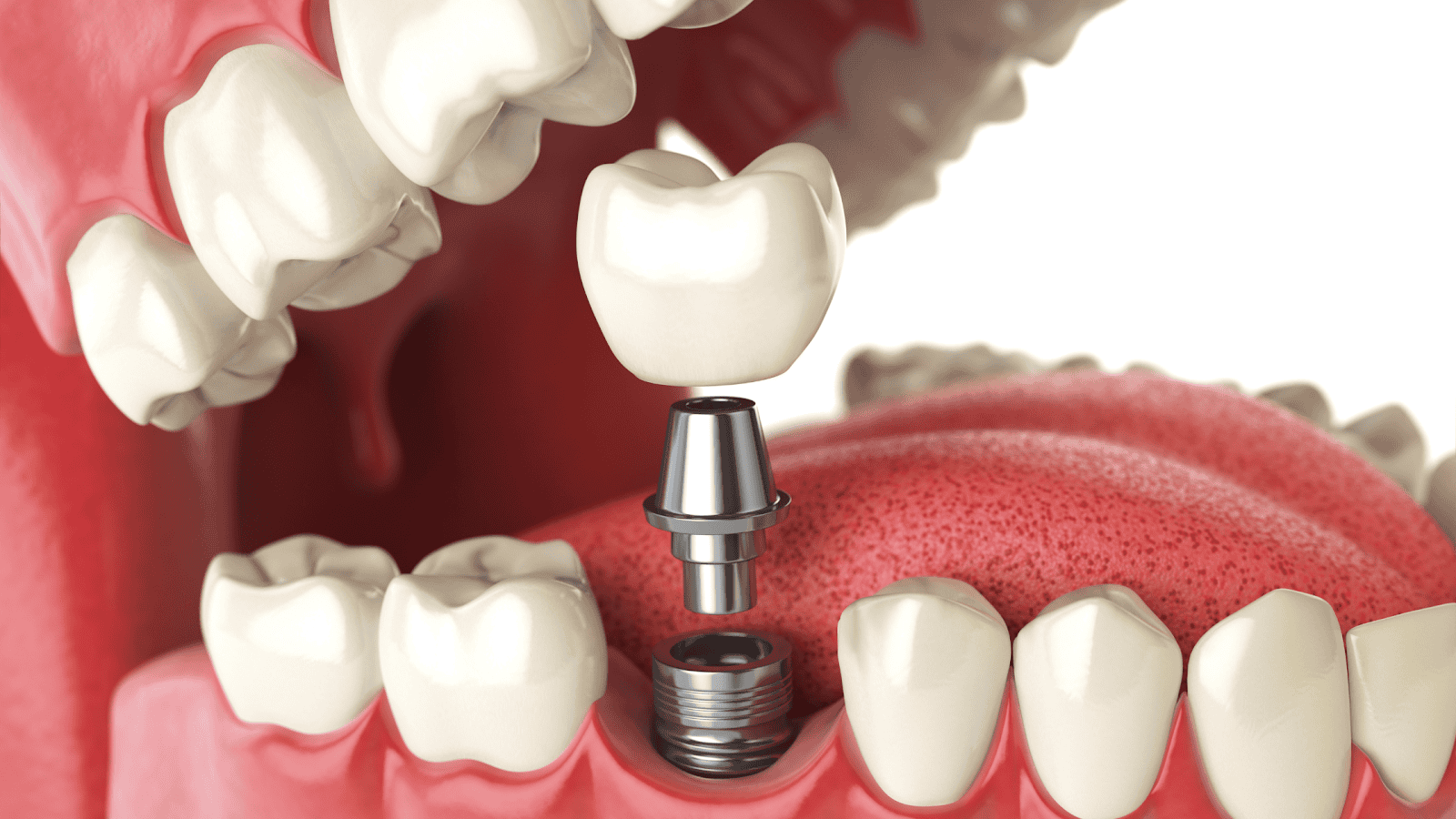 Same Day Dental Implant