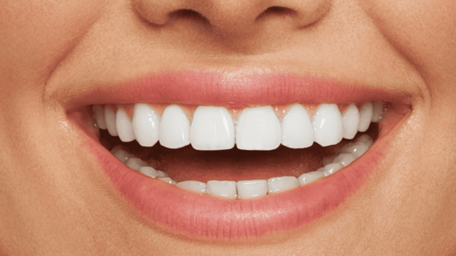 Crooked Teeth and Composite Bonding
