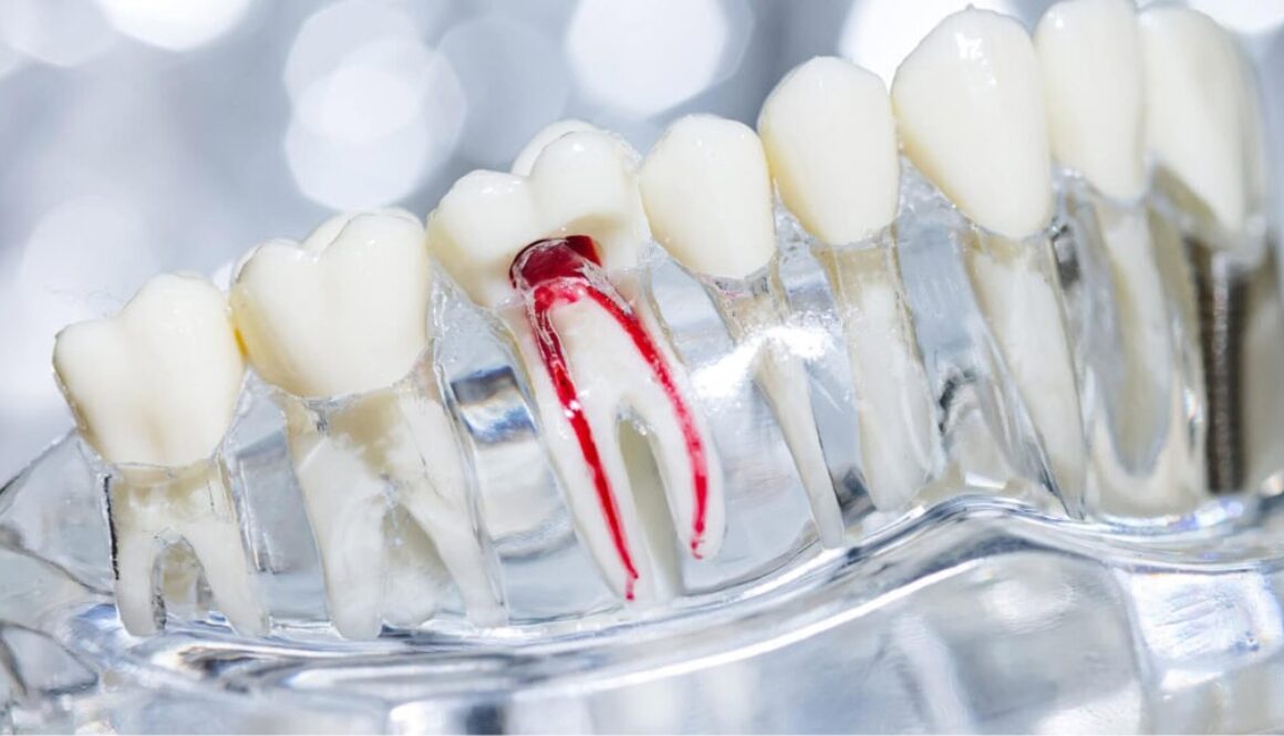How Long Does a Root Canal Take? Complete Timeline and What to Expect