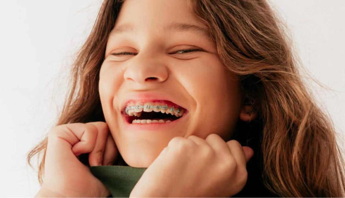 How Long Does It Take to Put on Braces