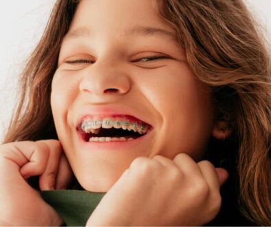 How Long Does It Take to Put on Braces