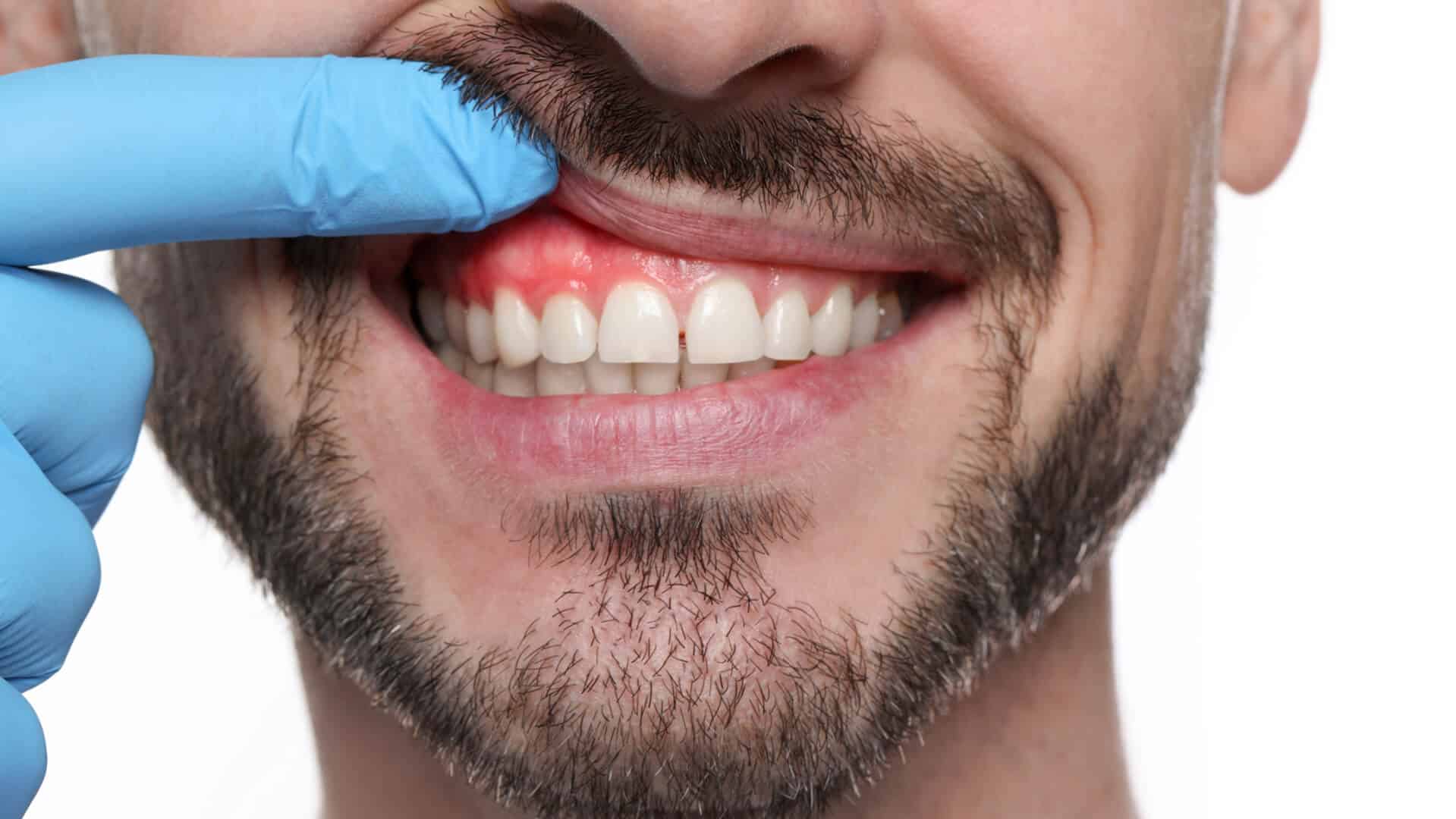 Pale-Gums-What-They-Mean-and-When-to-See-a-Dentist Pale Gums – What They Mean and When to See a Dentist