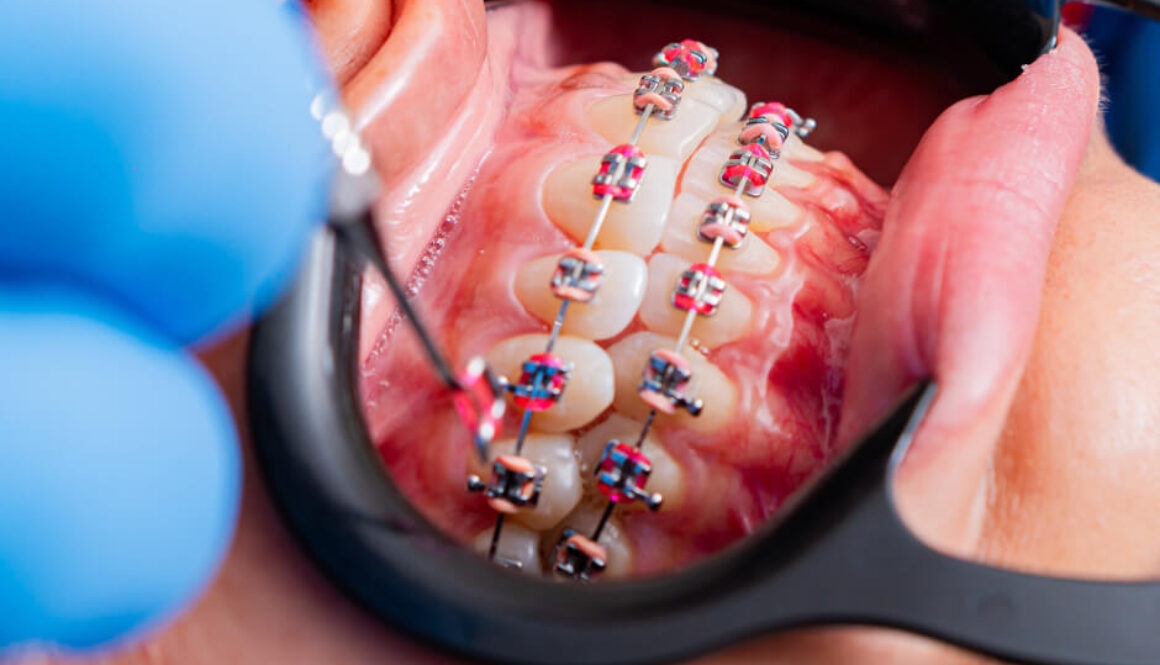How much are braces, and what does professional orthodontic care really include?