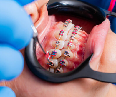 How much are braces, and what does professional orthodontic care really include?