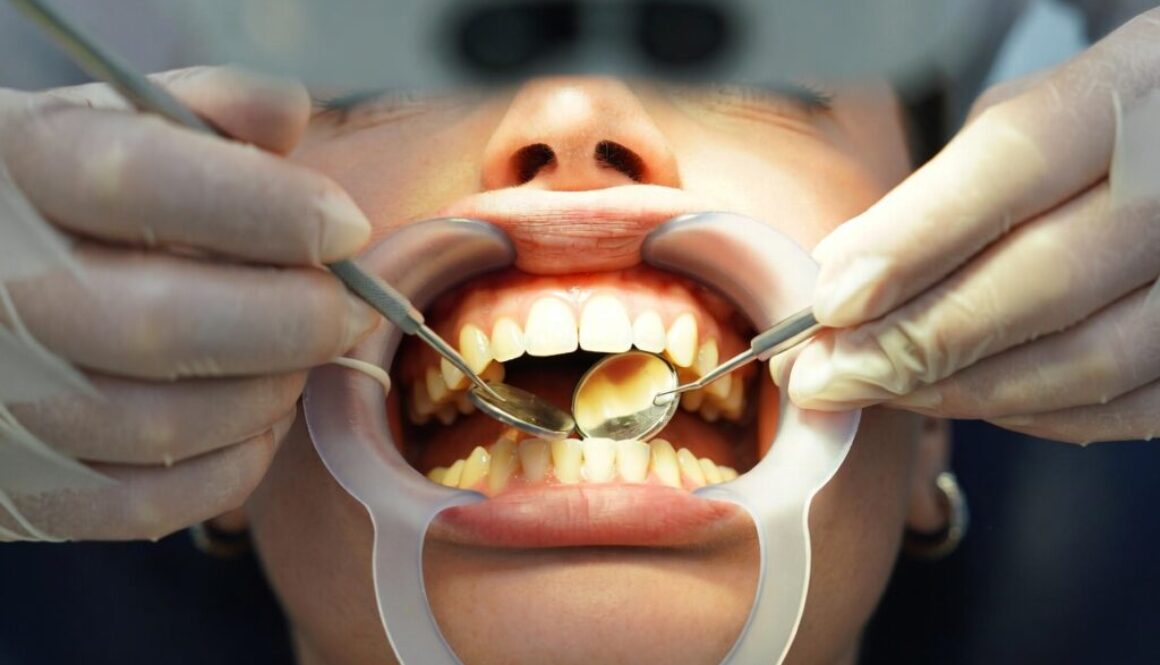 Best Teeth Whitening Options in London Explained