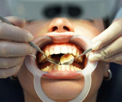 Best Teeth Whitening Options in London Explained