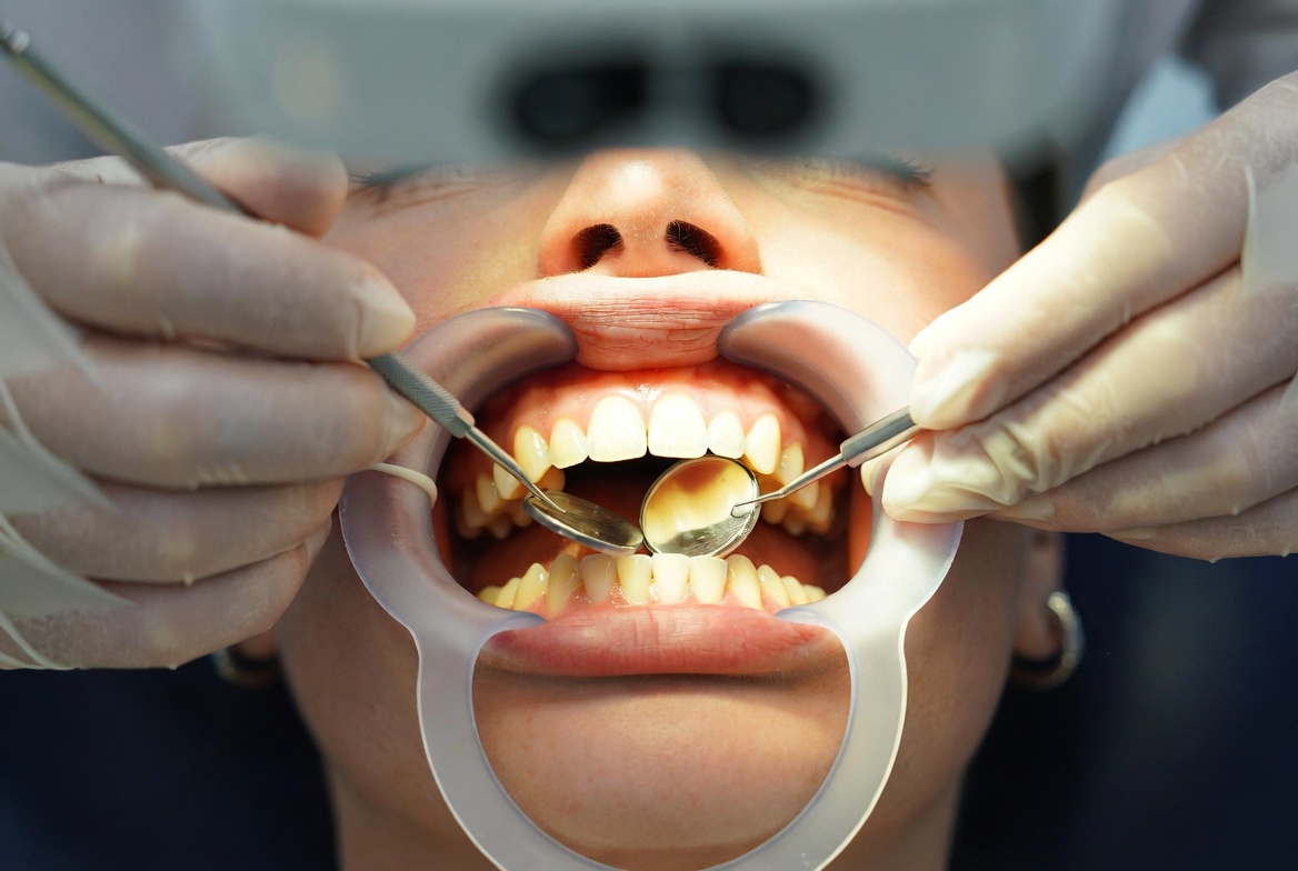 Best Teeth Whitening Options in London Explained