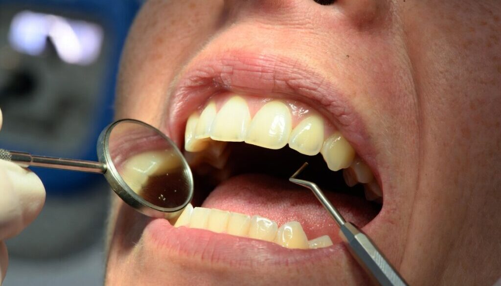 Composite Bonding After 5 Years: What to Expect
