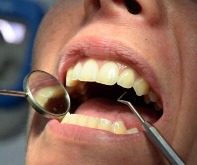Composite Bonding After 5 Years: What to Expect
