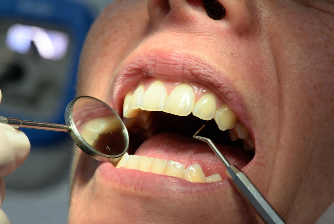 Composite Bonding After 5 Years: What to Expect
